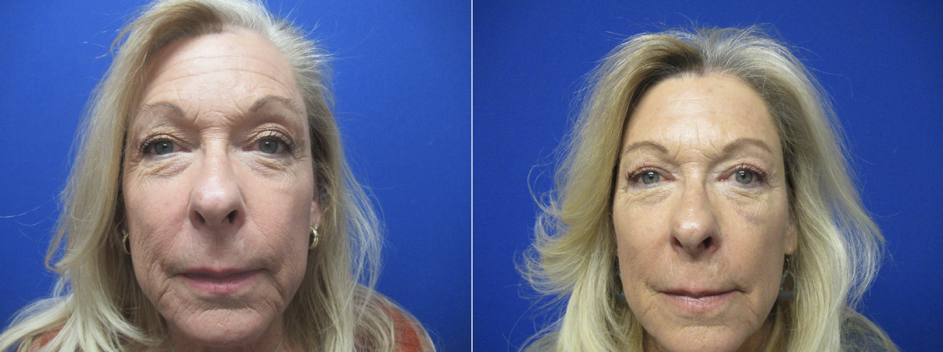 Upper Blepharoplasty Before and After